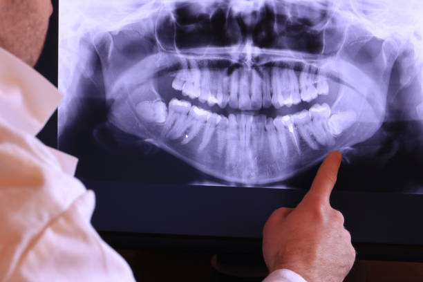 Best Knocked-Out Tooth (Avulsed Tooth) Treatment in Crafton, PA